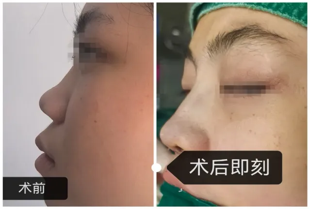 萍矿总医院医学美容科成功开展首例自体耳软骨隆鼻术，鼻部精雕技术迈入新阶段！