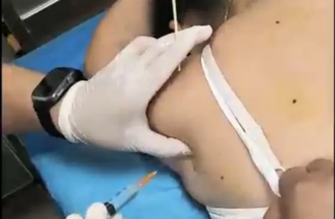 抬臂时肩膀像被 “冻住”？萍矿总医院疼痛科提醒：警惕肩周炎，这些知识要知道！