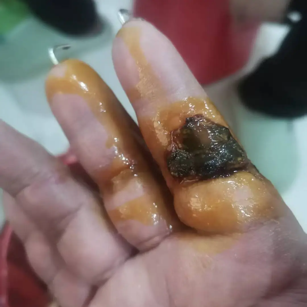 惊险！两指完全离断！萍矿总医院提醒：这些急救知识请牢记！
